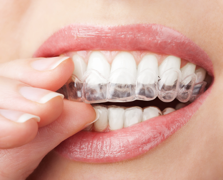 ClearCorrect: A Better Way to Have a Straighter Teeth, Fort Mill