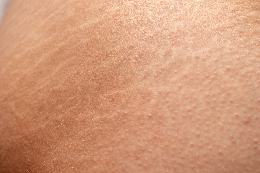 does cellulite cream work for stretch marks