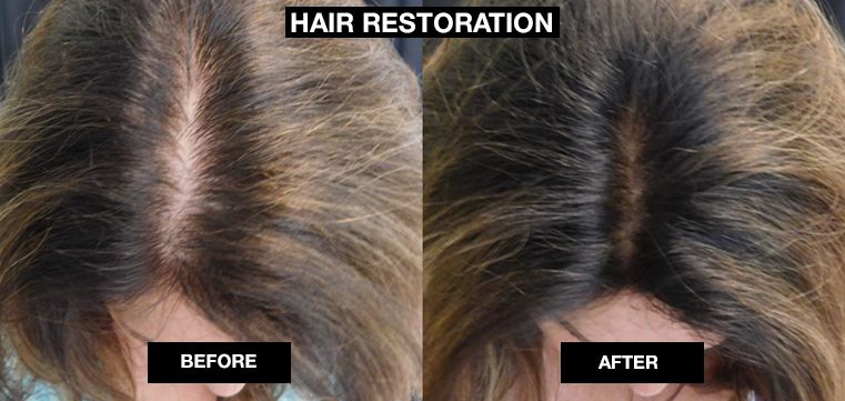 Hair Restoration With Platelet-Rich Plasma | Reset Medspa Chicago, IL