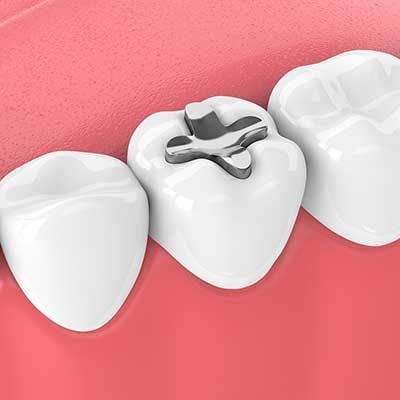 Dentures in Spanish Fork, UT | Creekside Dental | Dentures in 84660