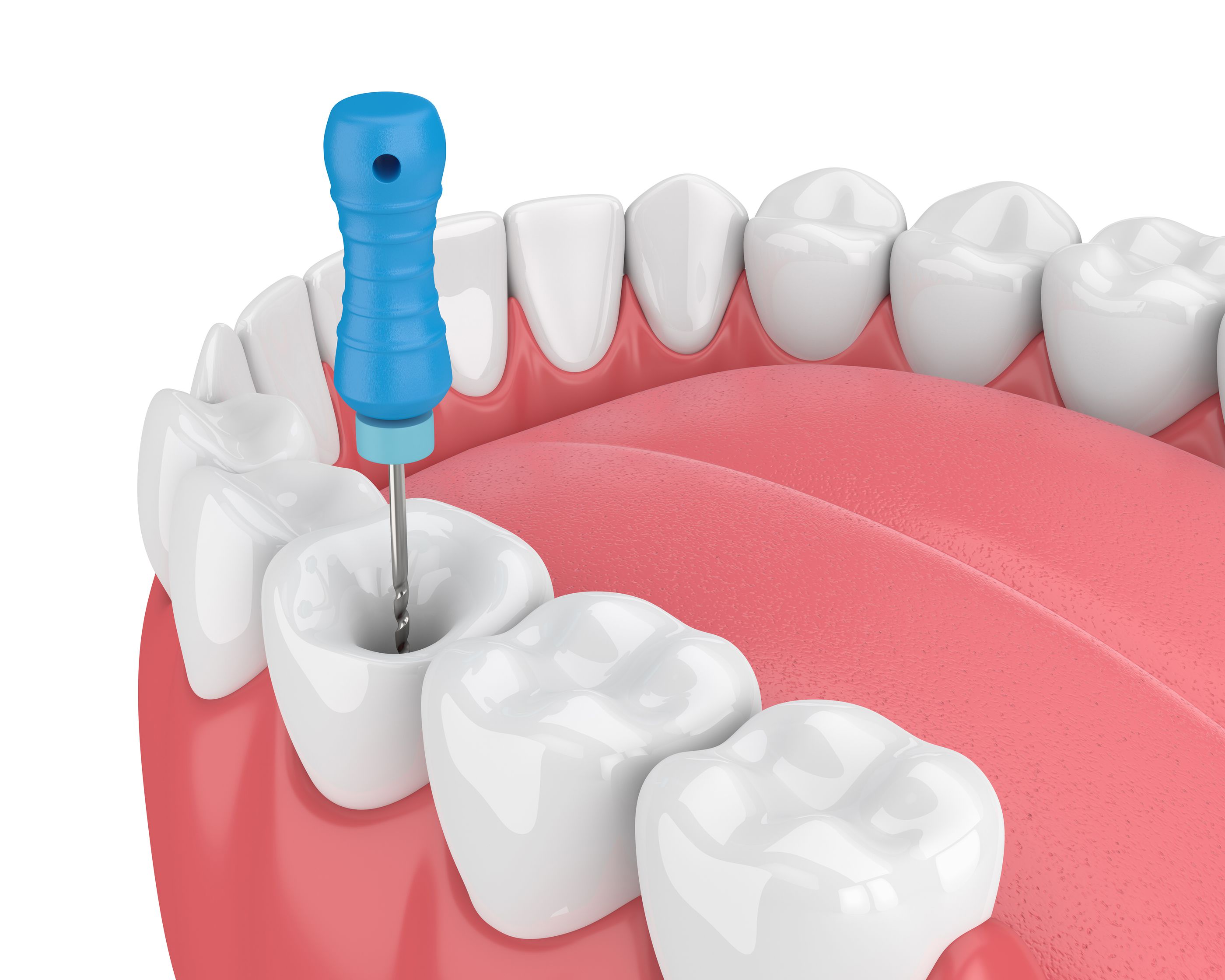 Common Endodontic Procedures