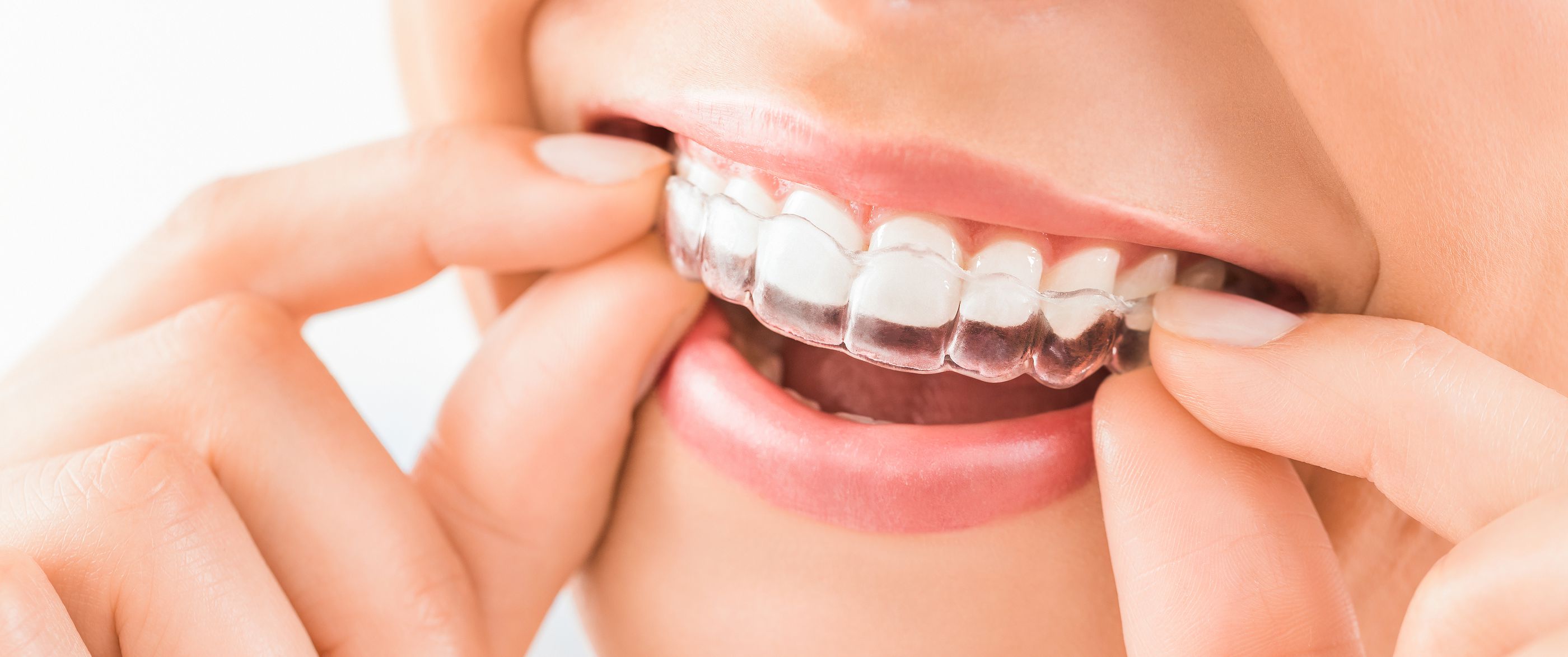 After Invisalign: How Many Hours A Day Will I Need To Wear A Retainer? | Montpelier Family Dentistry Laurel, Md