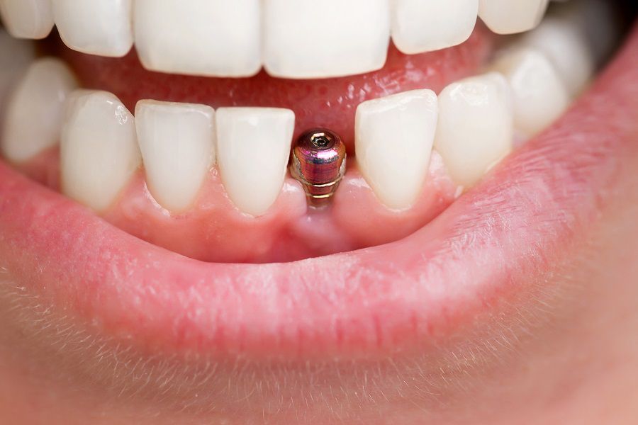 A DENTAL IMPLANT CAN BE USED TO REPLACE A TOOTH LOST TO UNTREATED DECAY