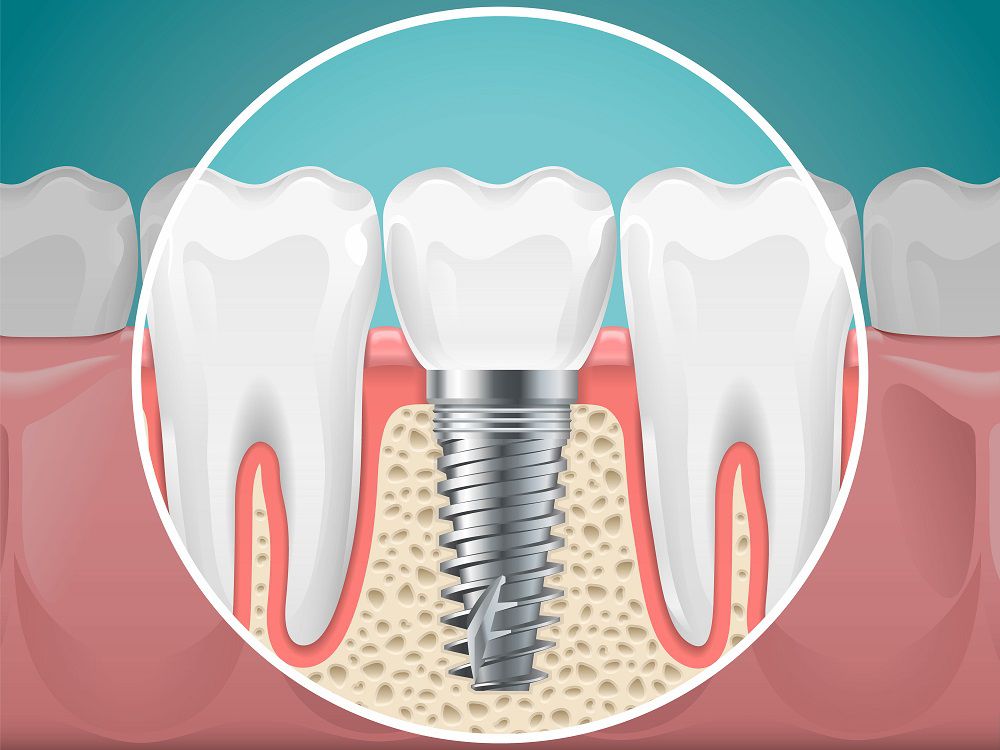 common causes of tooth loss