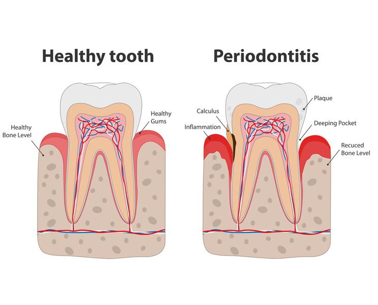 Gum Treatment Miami Florida 