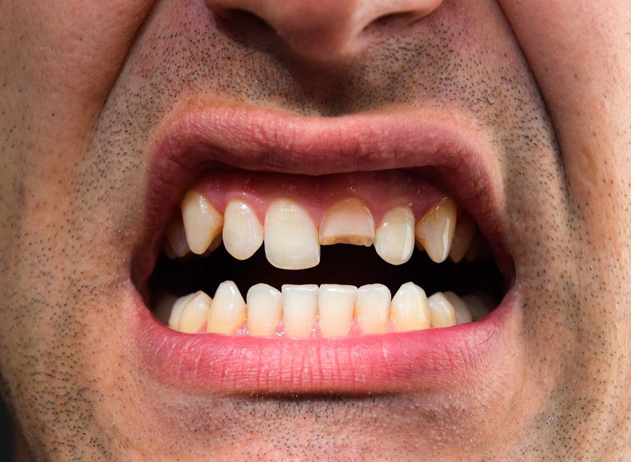 Blogs Family and Cosmetic Dentist Draper, UT