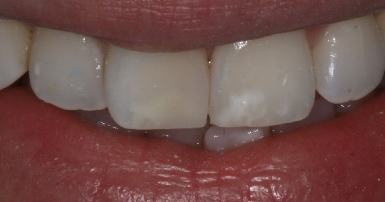 Tooth cavity filling by silver and composite material - Preferred Dental