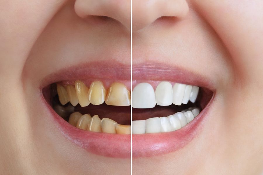 How Long Does It Take To Whiten My Teeth? | Mountain View Advanced