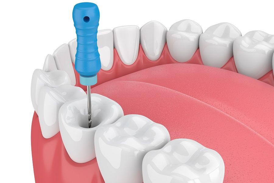 Root Canal PostOp Instructions Dental Solution Odessa, TX & Midland, TX