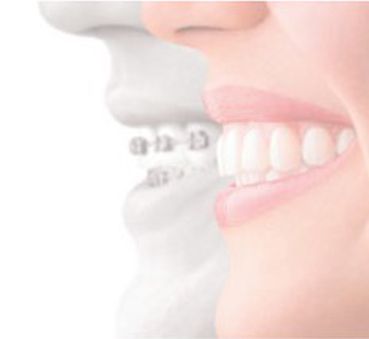 Invisalign® Clear Aligners  Best Invisalign Dentist in Honolulu, HI