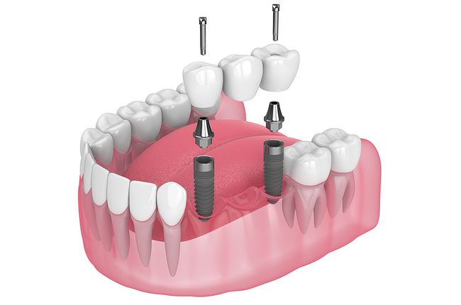 Dental Bridges