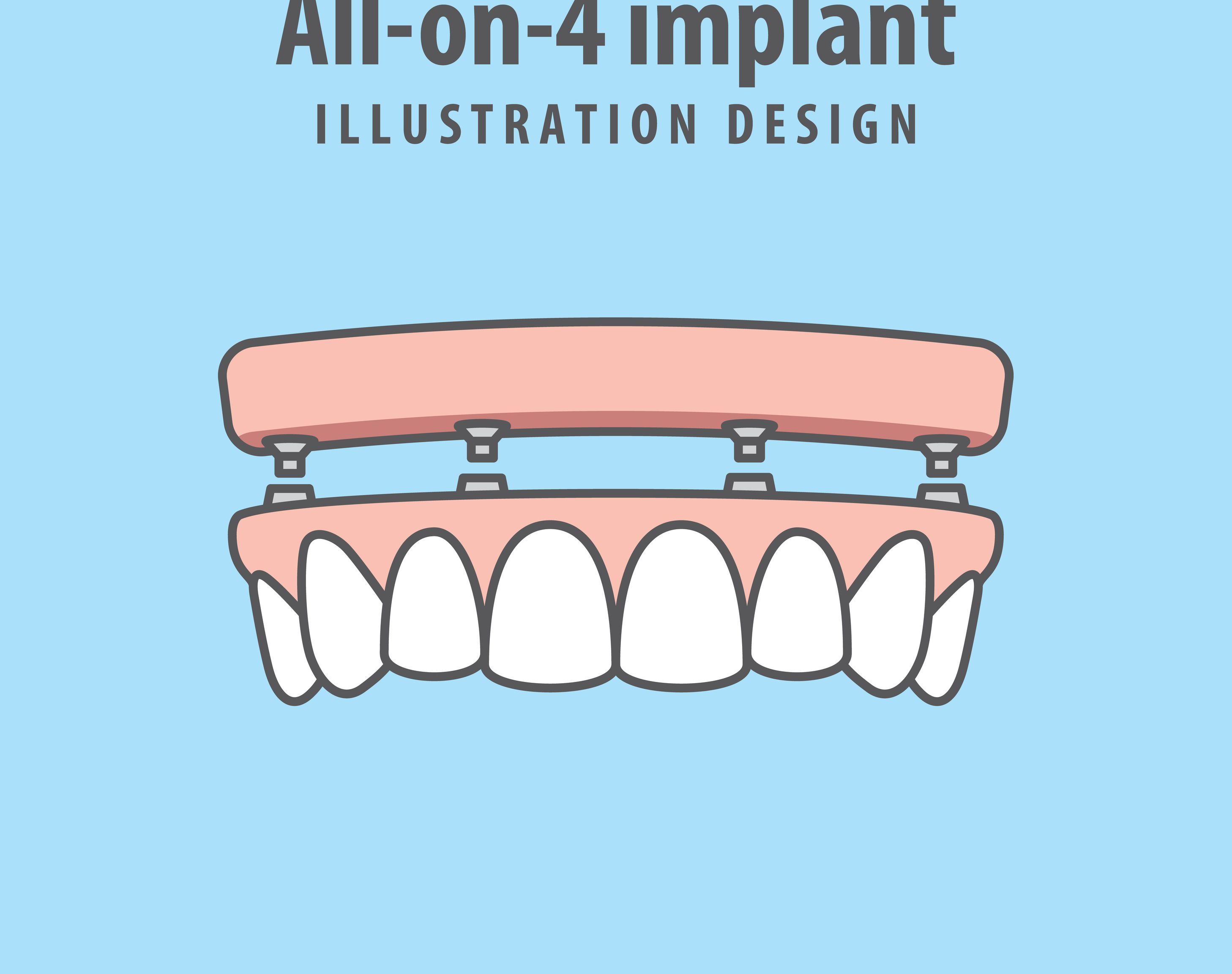 Why choose Allon4 implants? Stone Dental GroupSE Chicago Dentistry