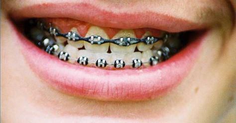 Braces