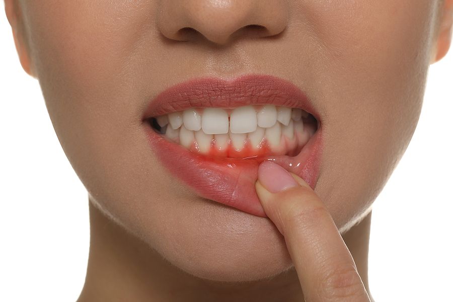 canker sore on upper gum