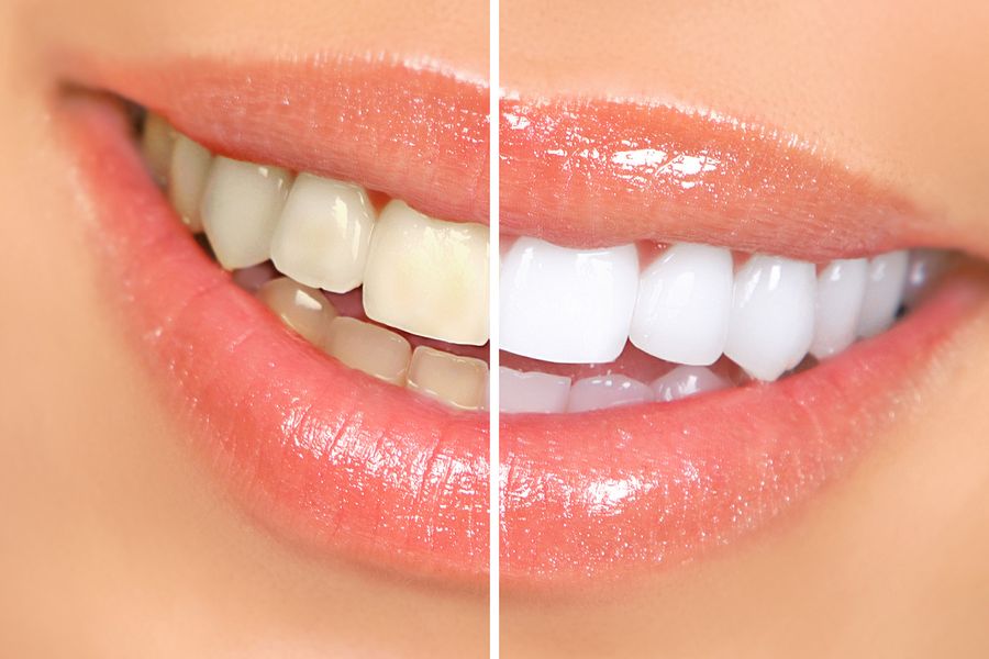 How Long Does It Take to Whiten Your Teeth? | Korte Family Dentistry