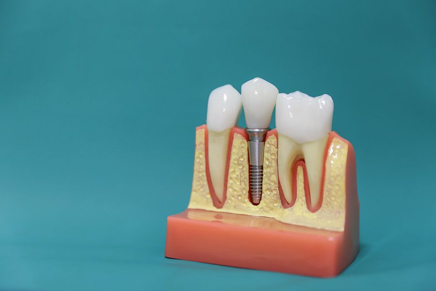 Dental Implants The Permanent Solution For Missing Teeth Dr Vlada