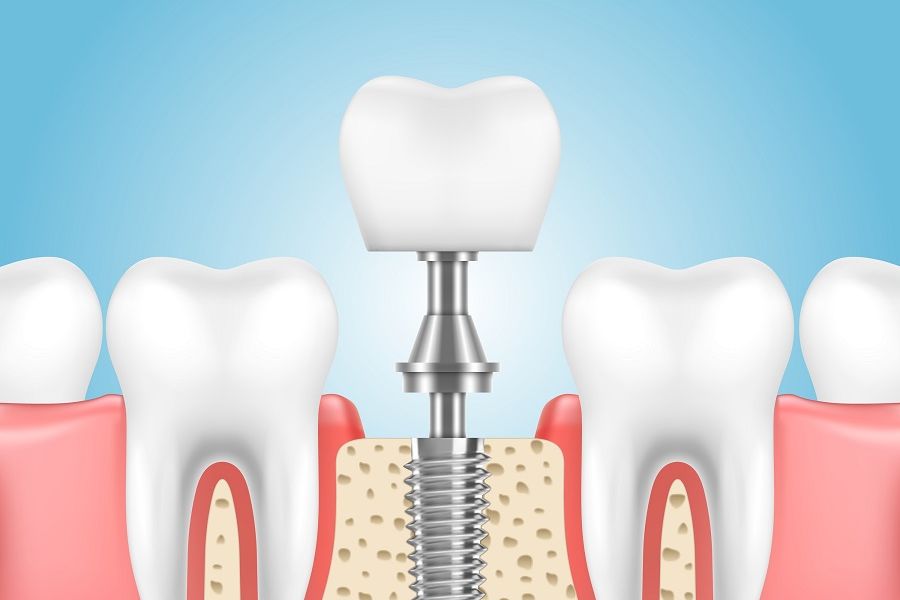 Dental Implants Process, Benefits, and Aftercare Cosmetic Dentist