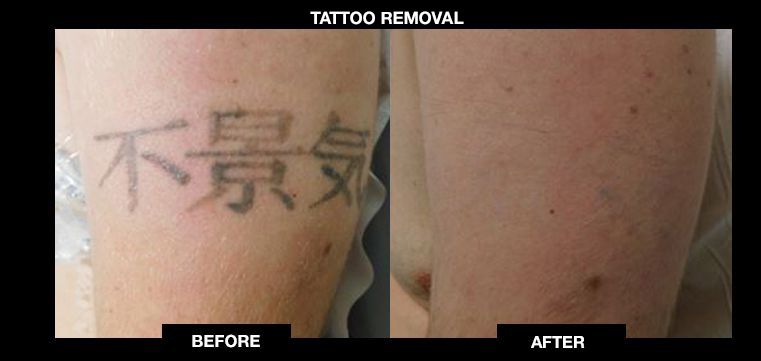 Permanent Fast Laser Tattoo Removal in Dulles Virginia  Northern VA Med  Spa