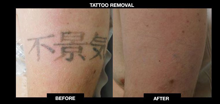 Picosure Laser Tattoo Removal Before and After. SAVE 25% OFF