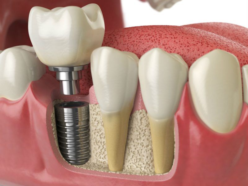Benefits of Dental Implants | Dentist for Life Las Vegas, NV