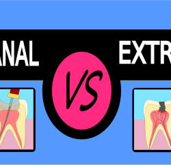 Endodoncia vs extracción, pros y contras