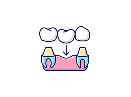 Dental Crowns and Bridges