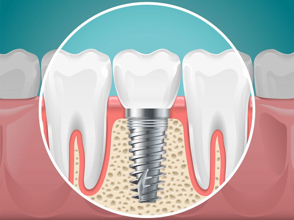 Benefits of Dental Implants | Cosmetic Dentist Santa Clarita, CA
