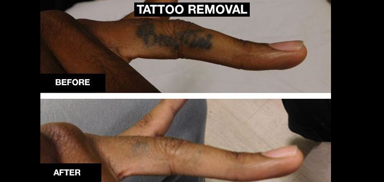 Laser Tattoo Removal Cost  Munster  Bare Tattoo  Hair Removal