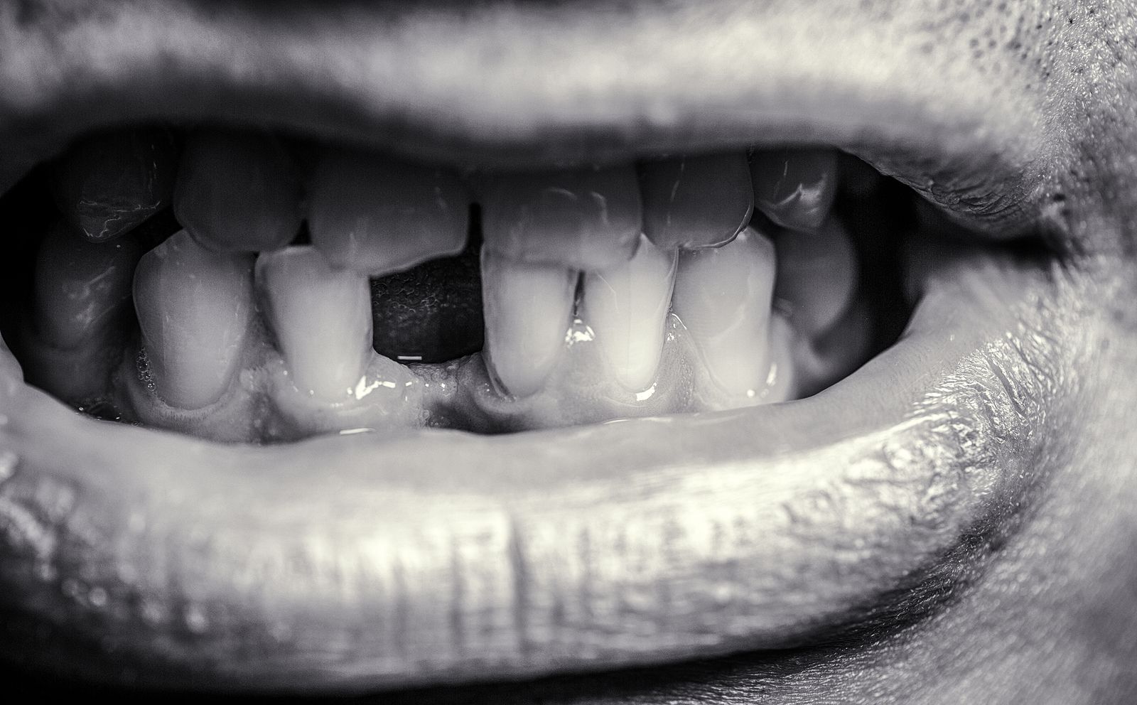 Knocked Out Teeth | Future Dental Care Redwood City