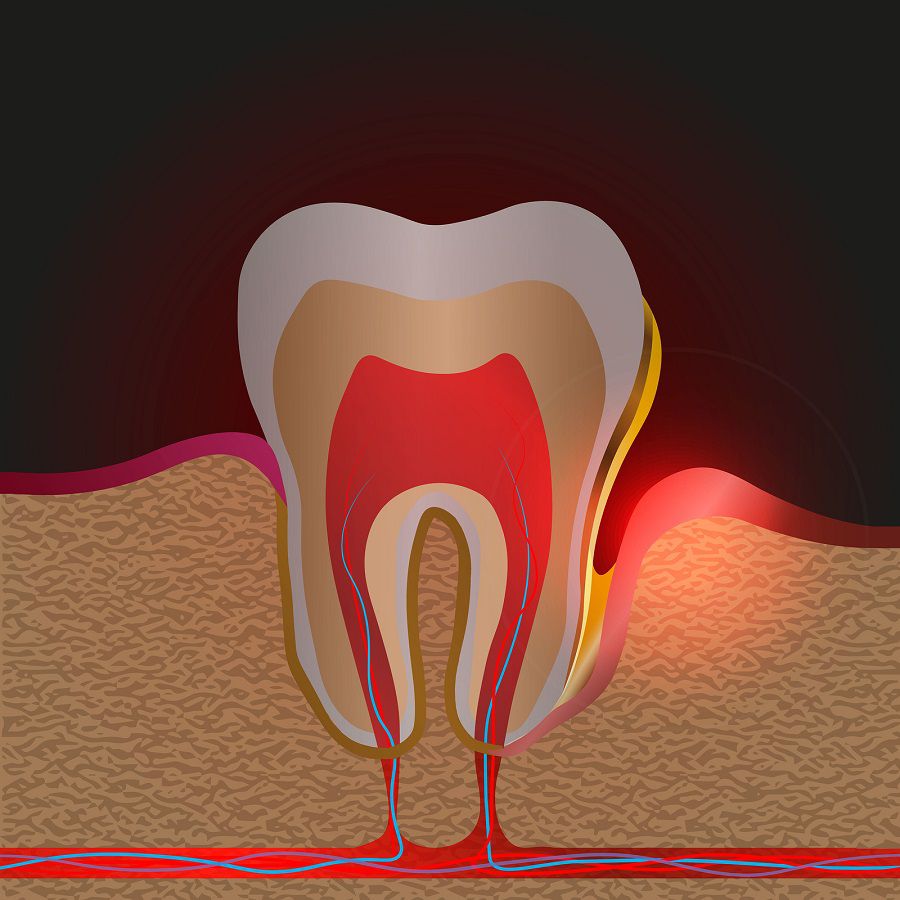 WHAT ARE THE SIGNS OF PERIODONTAL DISEASE THAT YOU SHOULD BE LOOKING FOR IN YOUR MOUTH OC