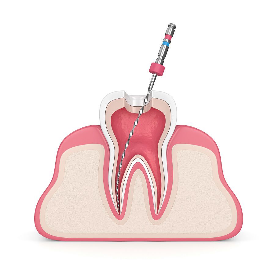 What Is A Root Canal? General, Family and Cosmetic Dentist Homewood