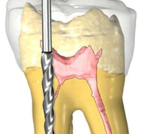 Root Canals