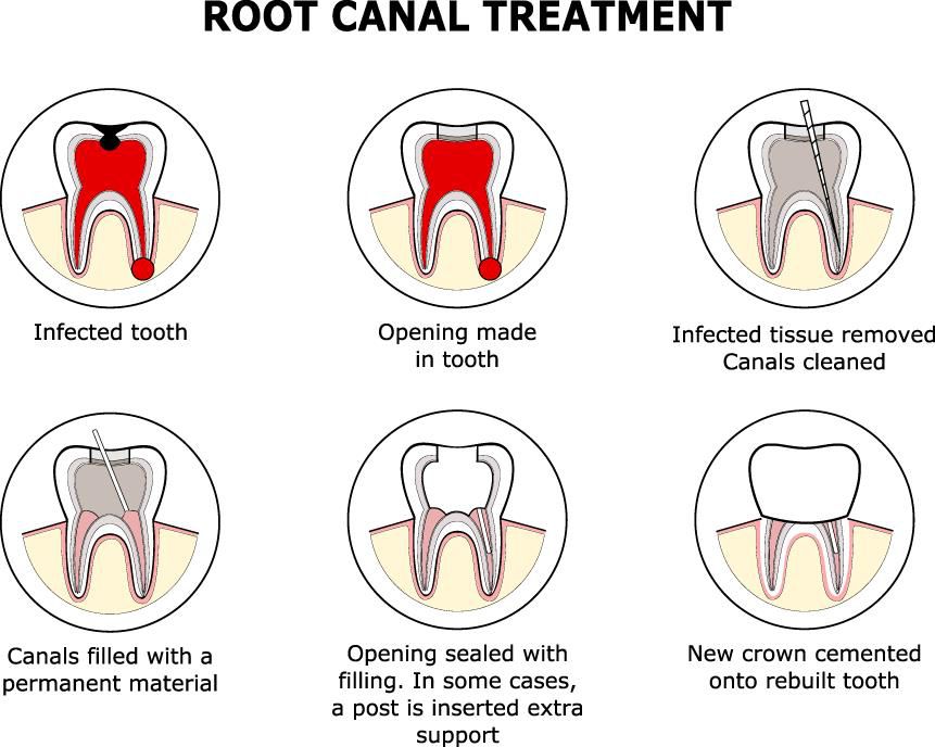 Root Canals in Sugar Creek, MO Enrich Dental Root Canals in 64054