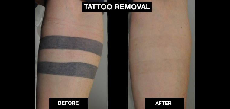 New Skin Clinic Laser Tattoo Removal Ipl E Light Hair Removal And Black Doll Hollywood Laser Peels Laser Tattoo Removal What To Expect Before After Photos