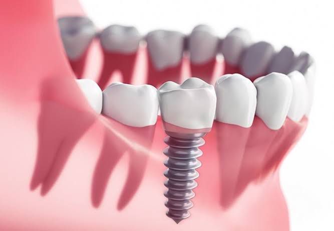 ¿Qué es un implante dental?