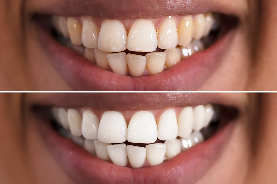 Boos worden Onveilig Overeenkomend Teeth Whitening Solution San Jose CA | Laser teeth whitening San Jose CA |  Teeth Discoloration Treatment San Jose CA