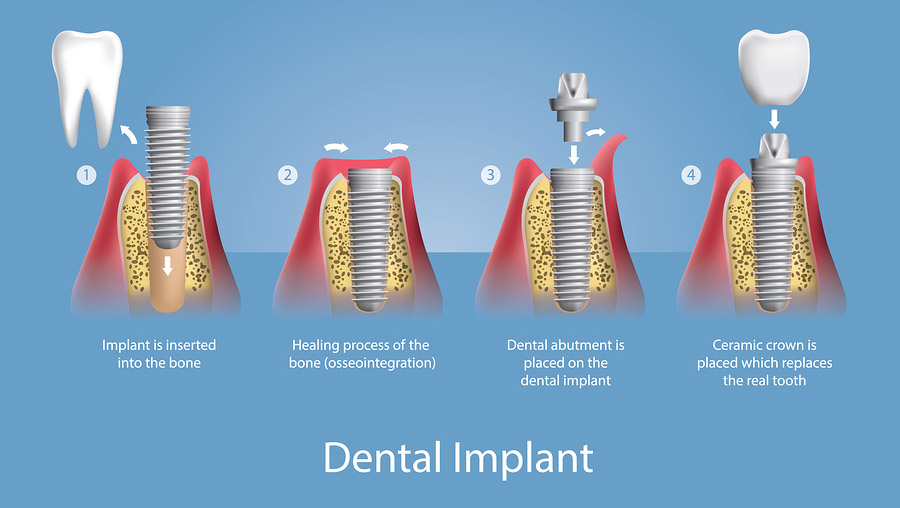 Same Day Crowns San Jose CA | Dental Crowns San Jose CA | Dental ...