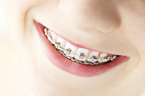 Braces  Violet Akhondzadeh, D.D.S., FICO, INC Whittier, CA