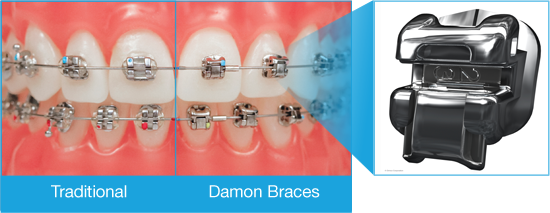 Traditional Braces  Unique Orthodontics