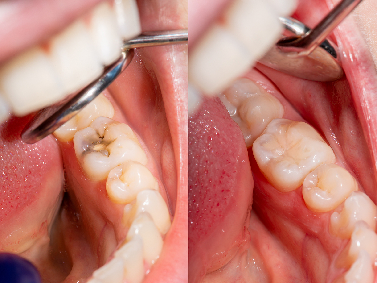 Composite vs Silver Dental Filling