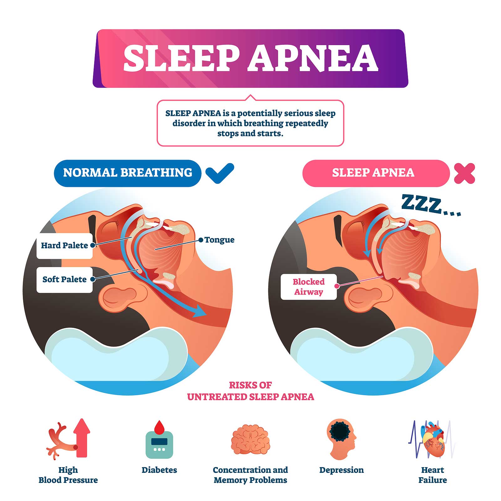 Obstructive Sleep Apnea Diagram