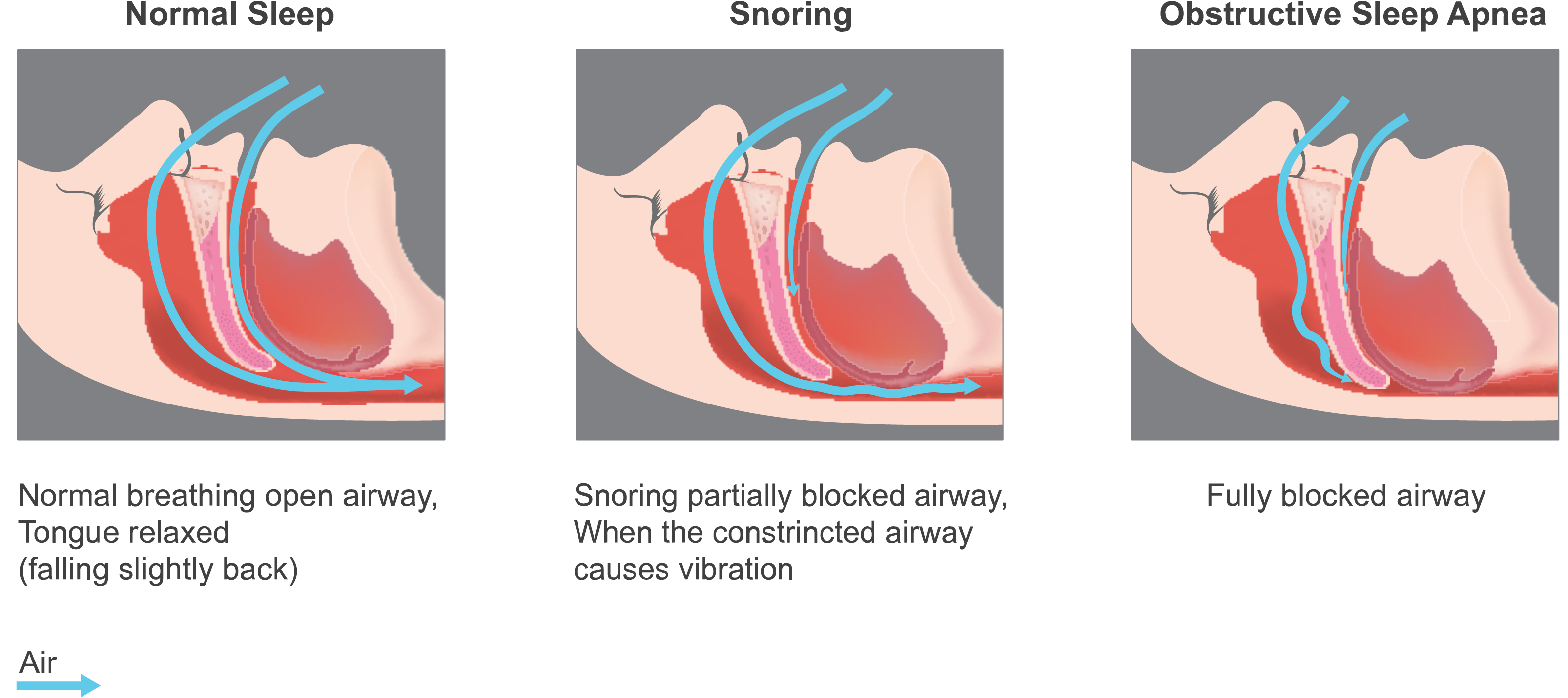 Sleep Apnea Meaning In Gujarati