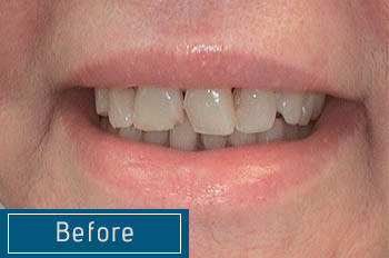 Before & After | Dentist Lakewood, Colorado
