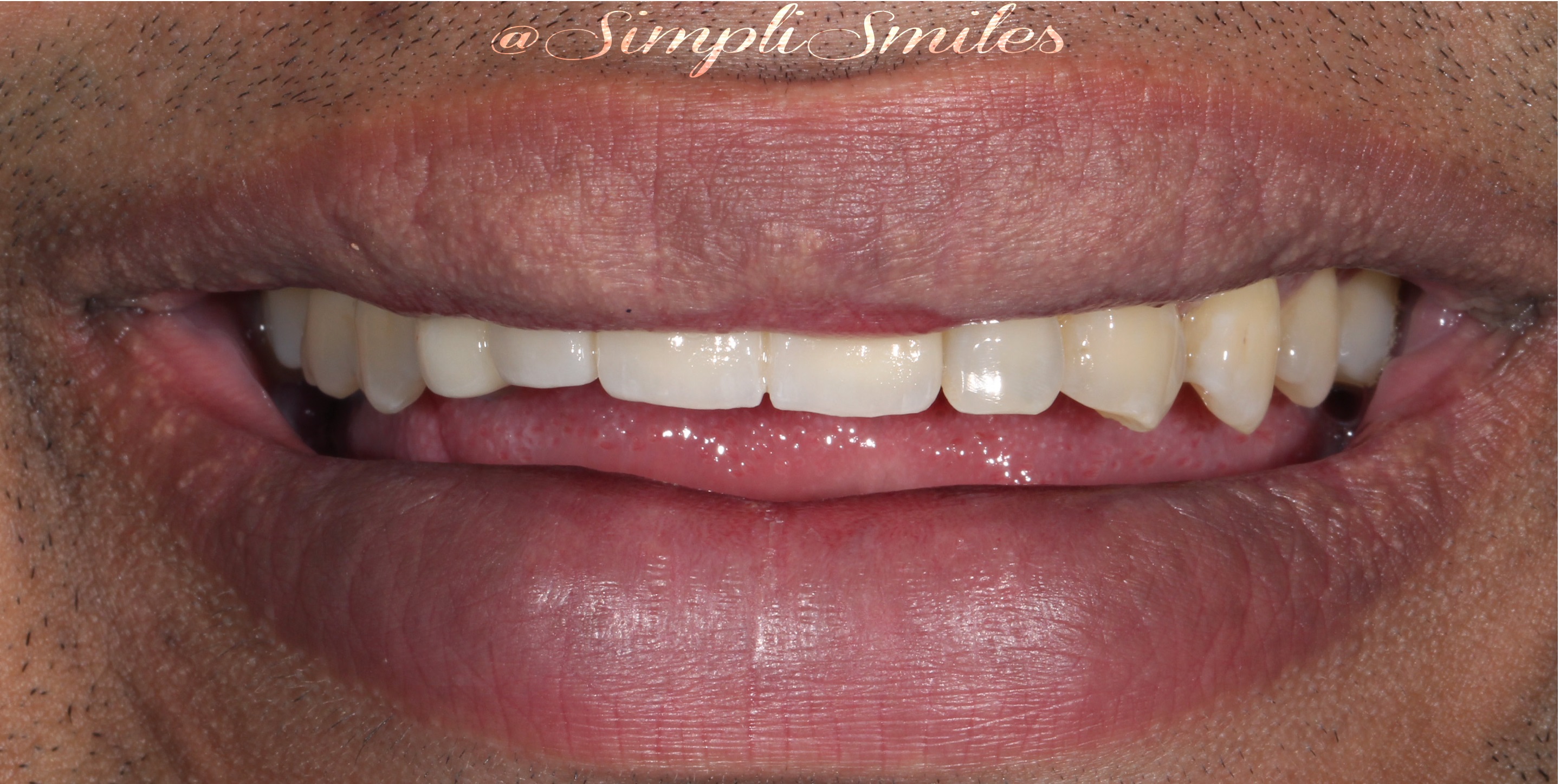 Smile Gallery SimpliSmiles Hicksville, NY & Farmingdale, NY