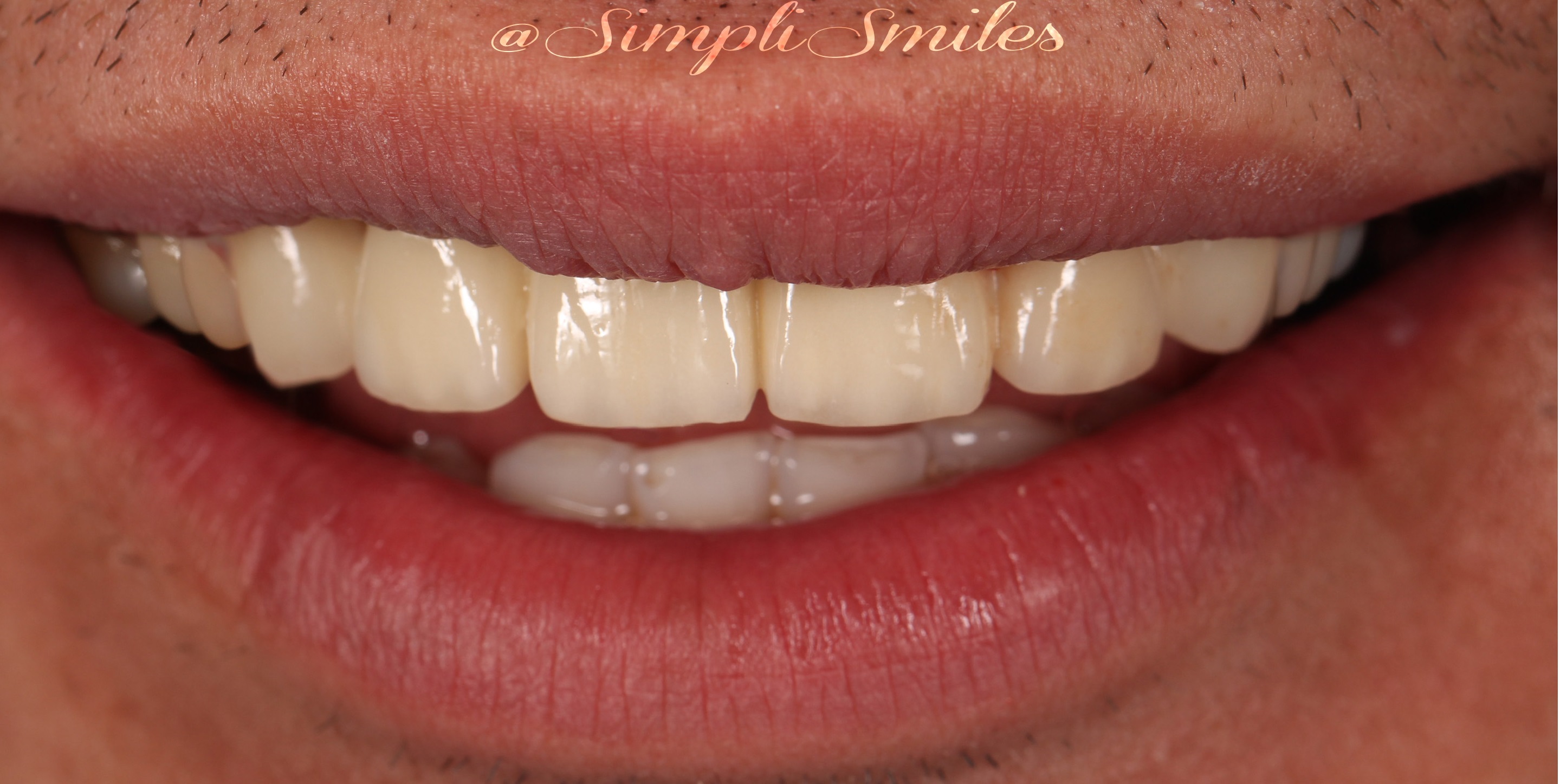 Smile Gallery SimpliSmiles Hicksville, NY & Farmingdale, NY