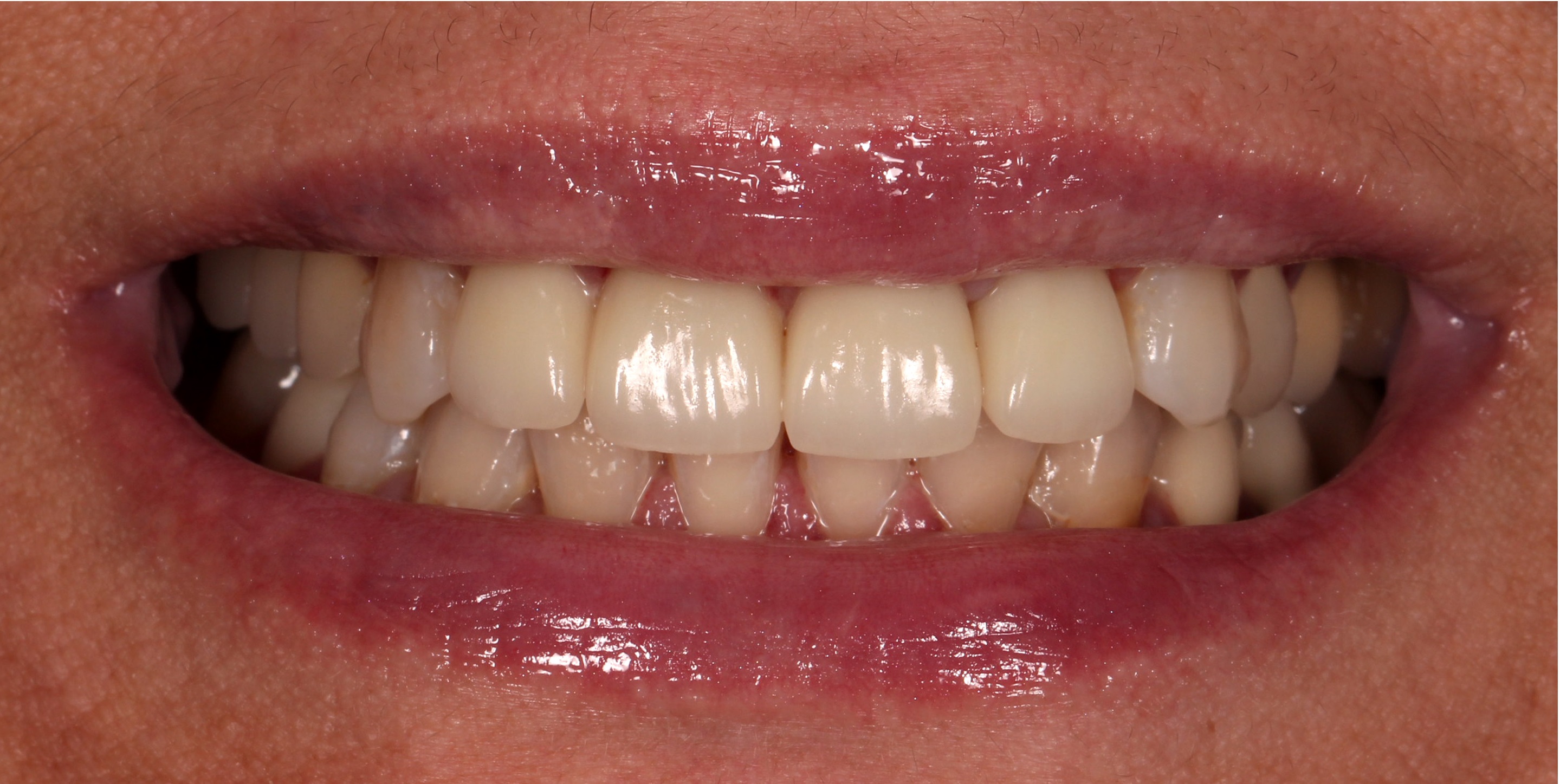 Smile Gallery SimpliSmiles Hicksville, NY & Farmingdale, NY