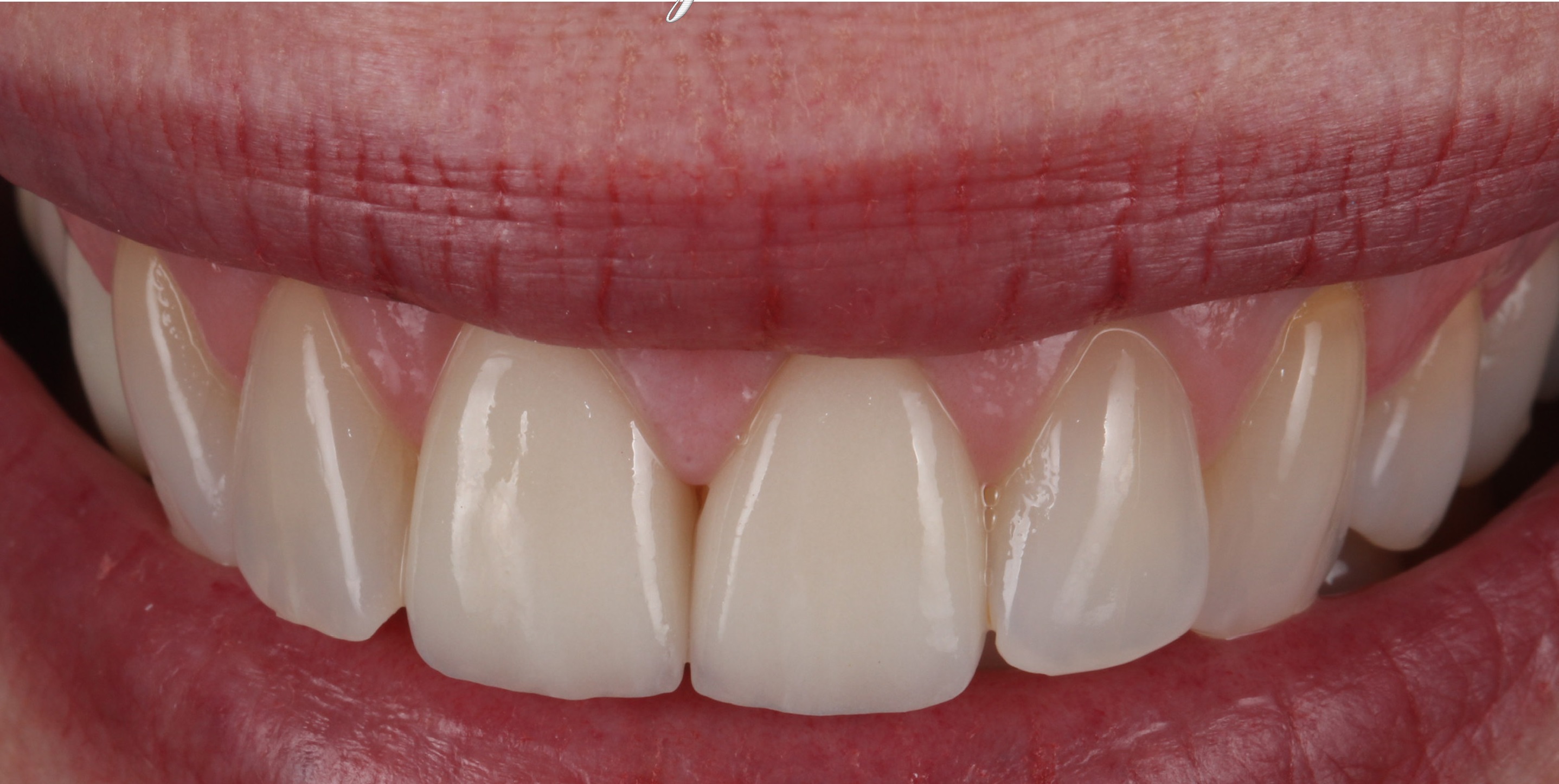 Smile Gallery SimpliSmiles Hicksville, NY & Farmingdale, NY