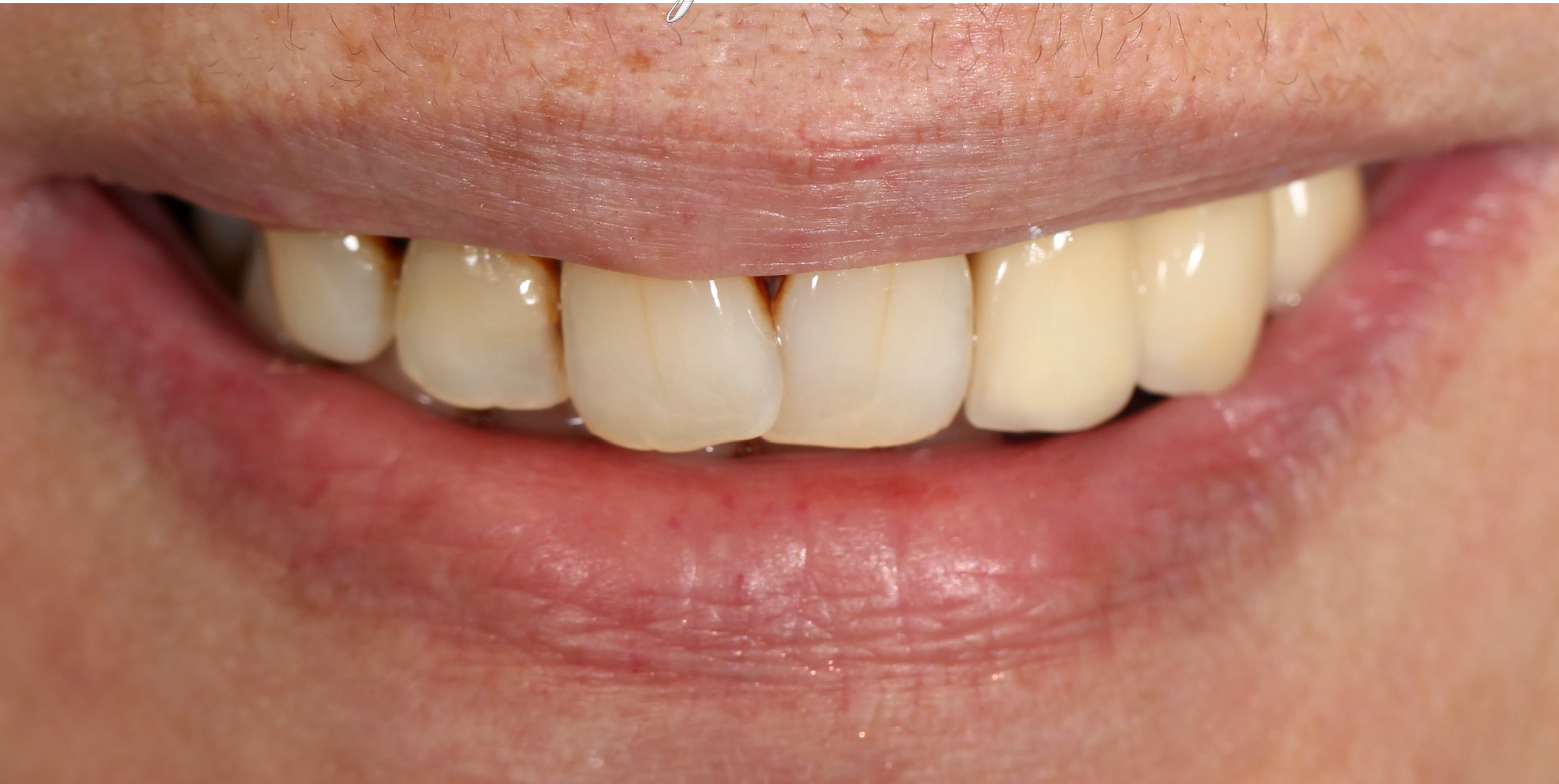 Smile Gallery SimpliSmiles Hicksville, NY & Farmingdale, NY