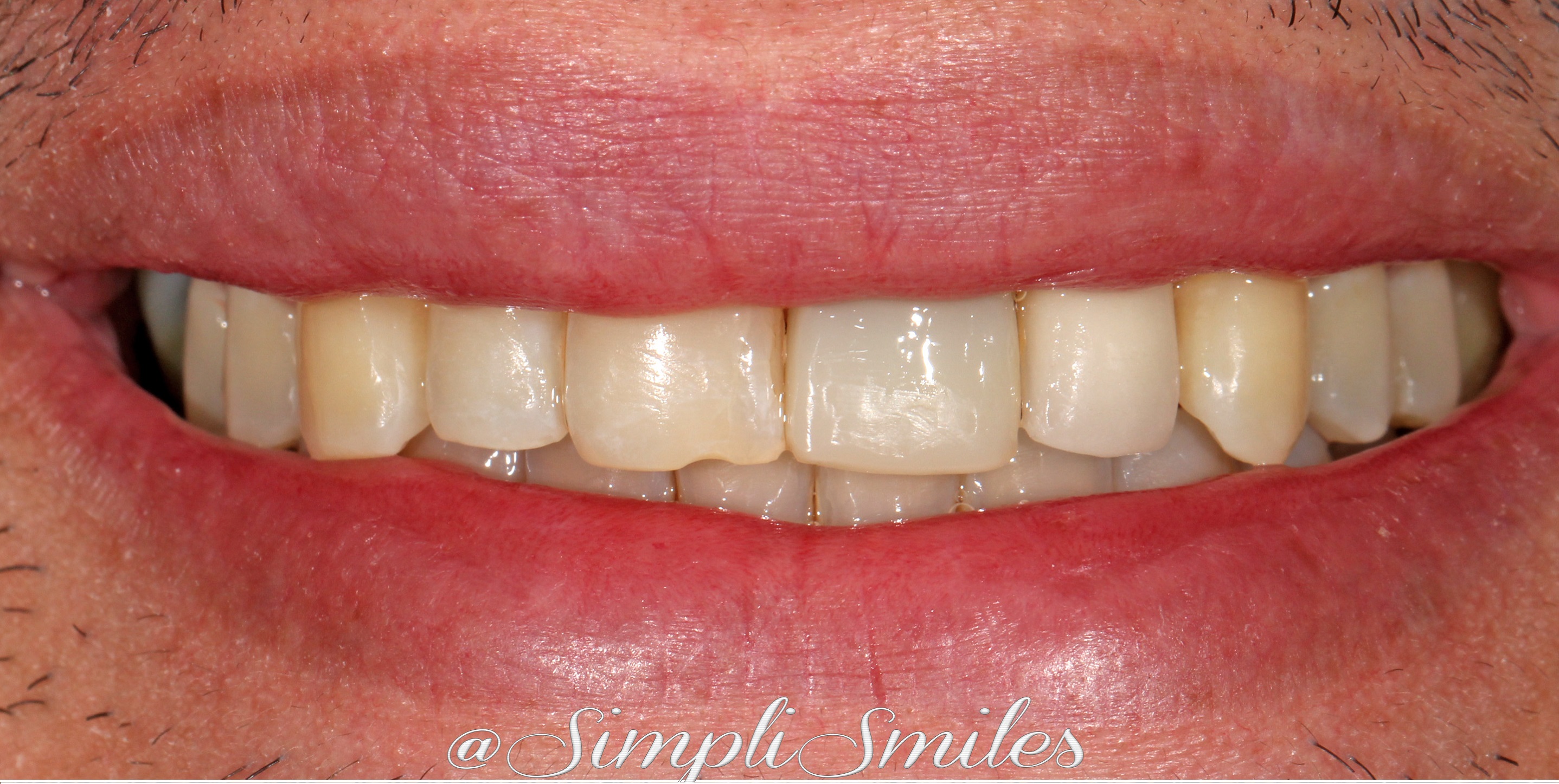Smile Gallery SimpliSmiles Hicksville, NY & Farmingdale, NY