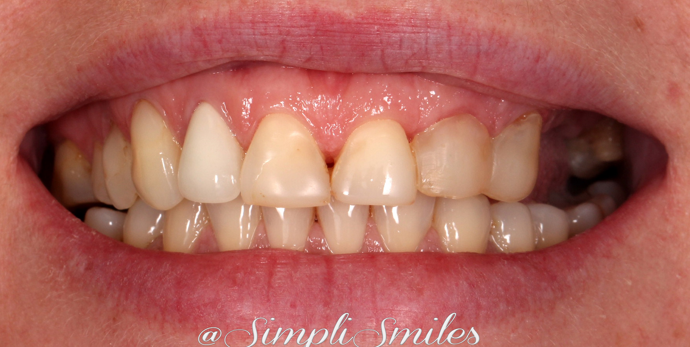 Smile Gallery SimpliSmiles Hicksville, NY & Farmingdale, NY